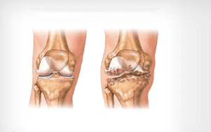 коленный остеоартрит