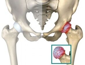 причины атроза тазобедренного сустава